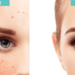 How To Get Rid Of Pimples In An Hour