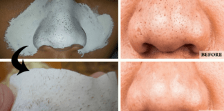 remove blackheads permanently
