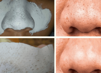 remove blackheads permanently