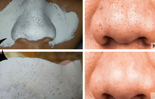remove blackheads permanently