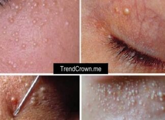 Get rid of annoying white skin cysts using these simple remedies!