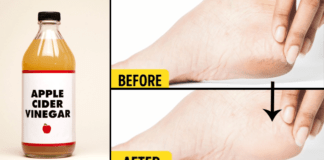 Heal cracked heels in week