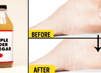 Heal cracked heels in week