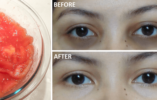 Remove Dark Circles In 3 Days
