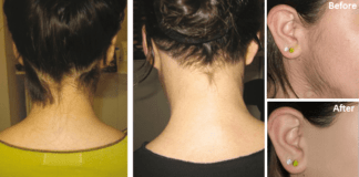 Get Rid of Unwanted Hair