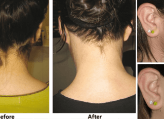 Get Rid of Unwanted Hair