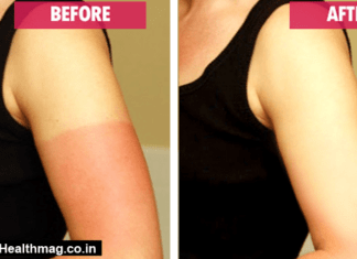 Heal Sunburn Fast