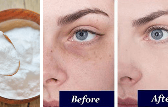 Remove Dark Circles