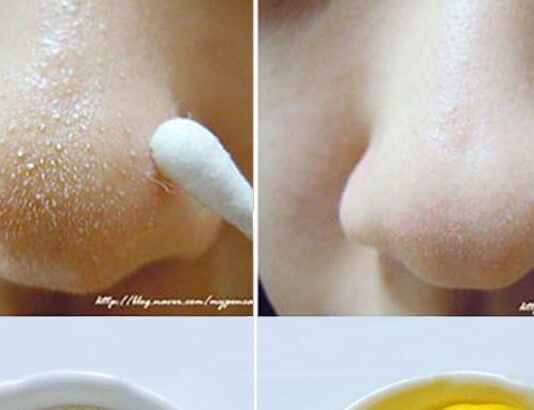 How To Get Rid Of Whiteheads On Nose And Face Remove whiteheads