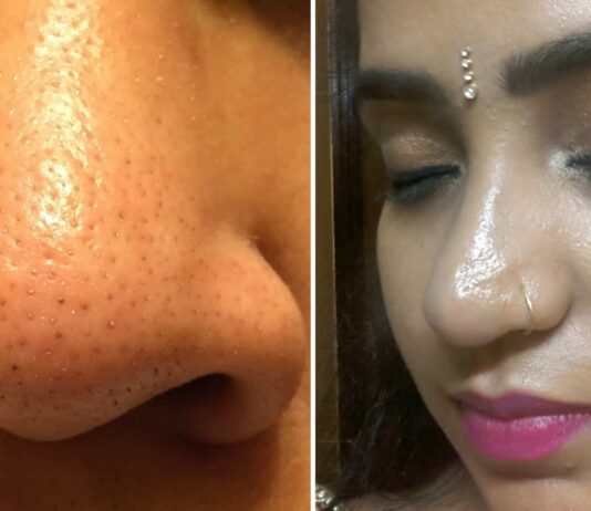 Home Remedies For Oily Nose. get rid of the oily nose