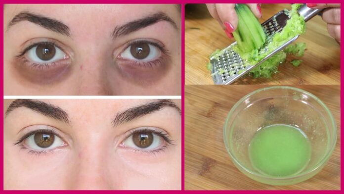 how-to-remove-dark-circles