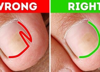 Perplexing ingrown toenails? Don’t worry!