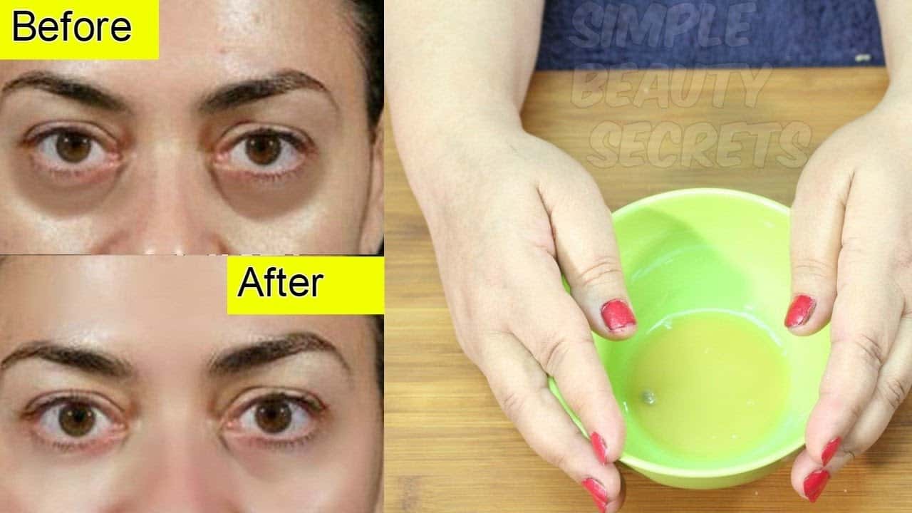 Get rid of dark circles naturally