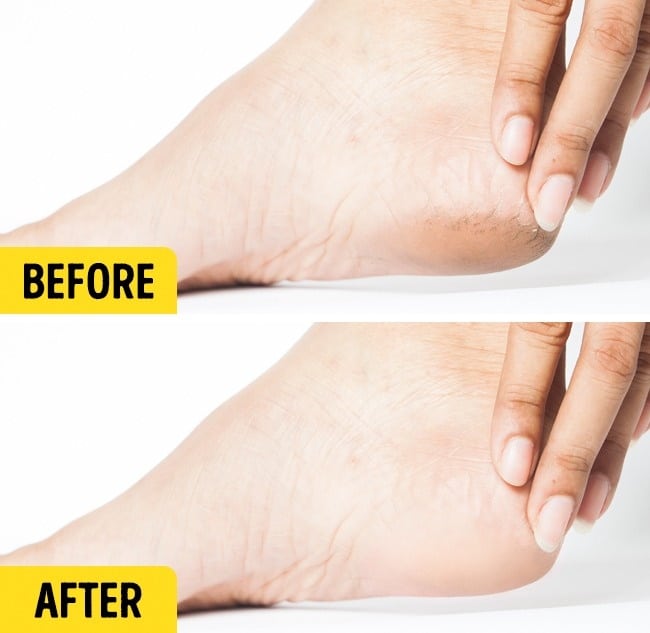 Heal cracked heels in week