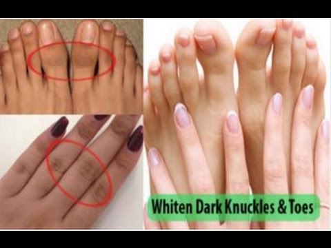 How to get rid of dark knuckles naturally
