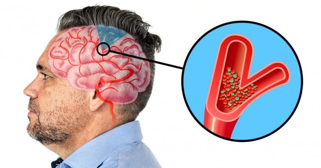6 Symptoms of upcoming brain Stroke