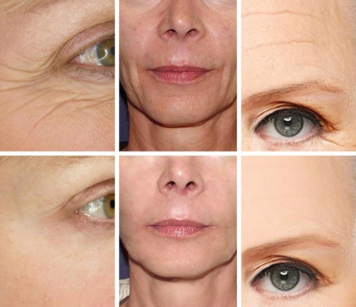 5 Best wrinkles products that has no side effects