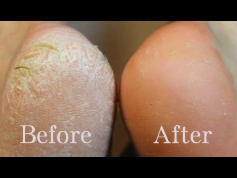 Home remedy to heal your cracked heels