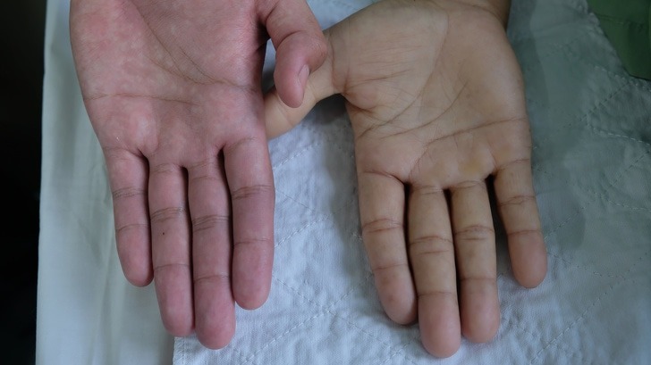 6 symptoms of anemia