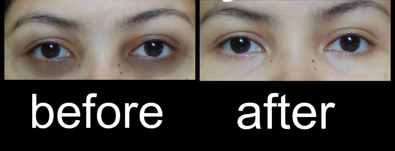 Remove Dark Circles In 3 Days