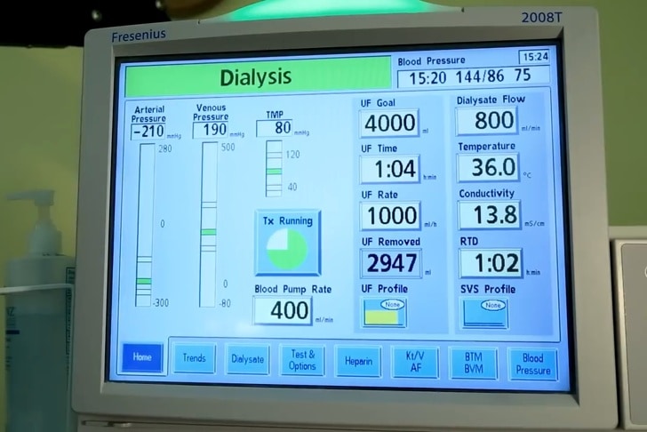 Scientists developed bionic kidney