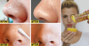 Remove Blackheads and Whiteheads