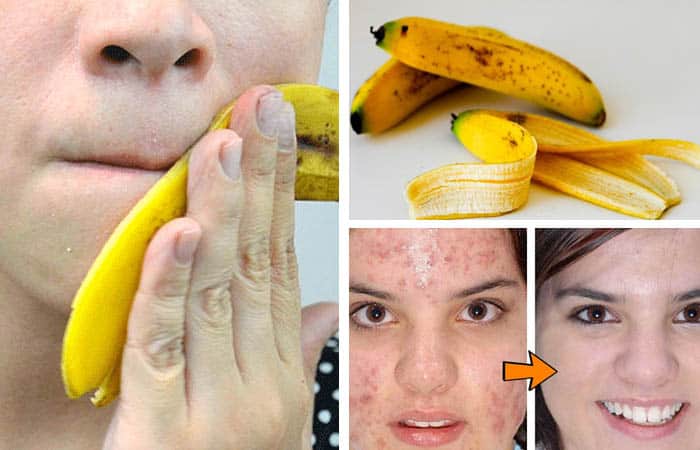 Benefits of banana peel