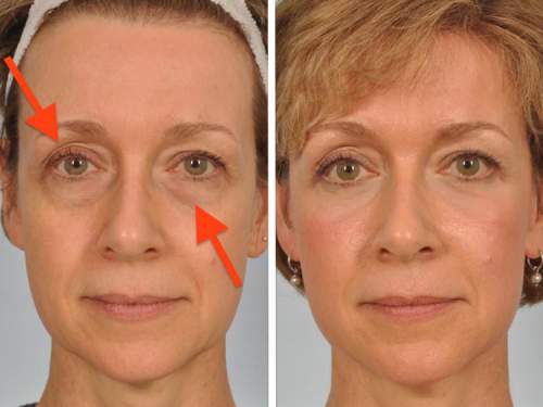 Solve your Sagging Eyelids Problem 
