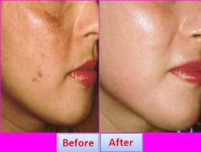 Best way to get rid of age spots