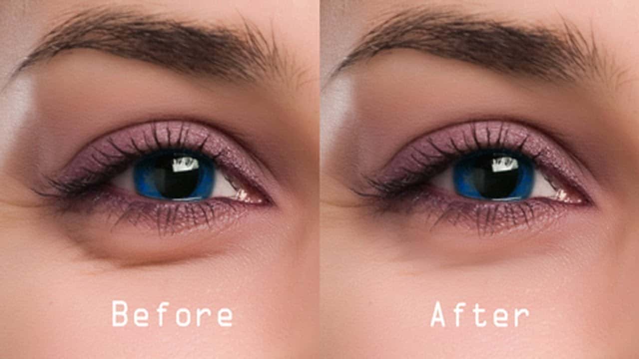 Get rid of eye bags