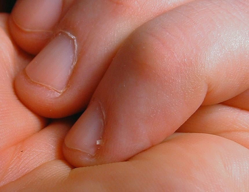 house for hangnails
