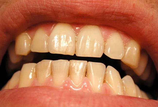 whiten your teeth in 3 minutes? 