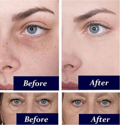 Remove Dark Circles
