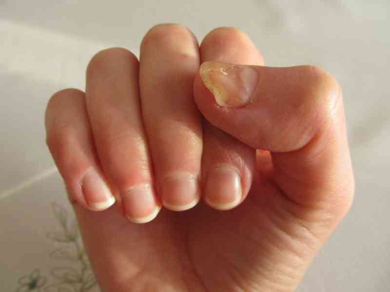 What Does Your Fingernails Indicate About Your Health