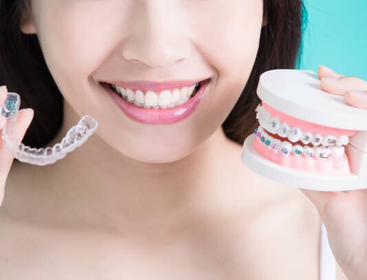 Will It Cost You A Fortune To Have Perfect Teeth?