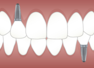 Dental Implants in Houston: Types and Procedure