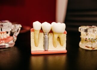 Can implants be placed one at a time? white and yellow wooden condiment shakers