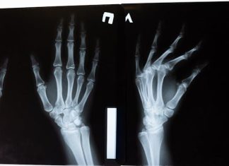 How to Seek Compensation for Broken Bones and Fractures After an Accident in Milwaukee