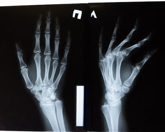 How to Seek Compensation for Broken Bones and Fractures After an Accident in Milwaukee